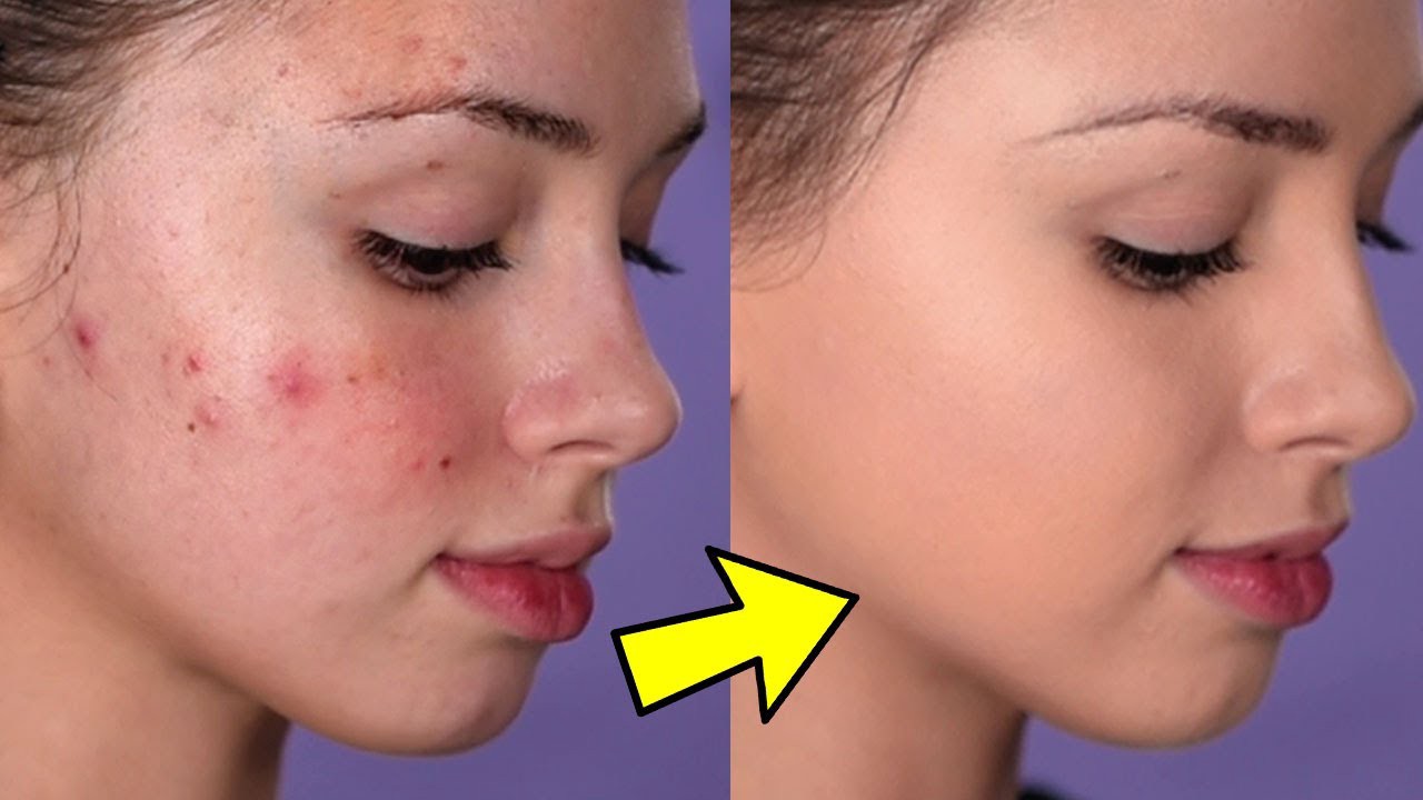 5 Tips For Getting Rid of Acne